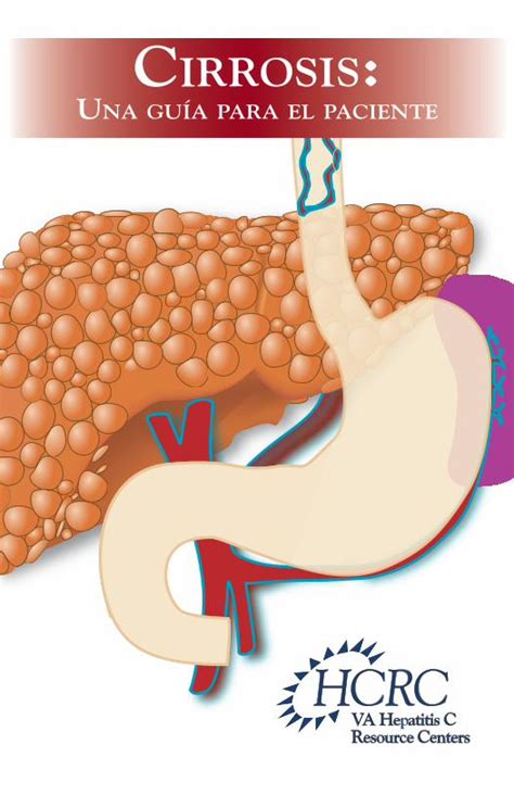 PDF Cirrosis Una Guia Para El Paciente HepatitisCualquier