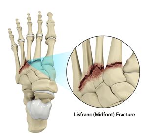 Intertarsal Joint