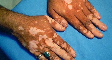 Breakthrough Scientists Cure Vitiligo In Patient Using Arthritis Drug