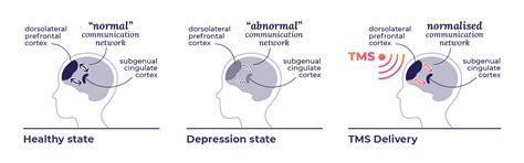 What Is Tms Queensland Neurostimulation Centre