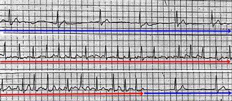 Sick sinus syndrom EKG Medicína nemoci studium na 1 LF UK