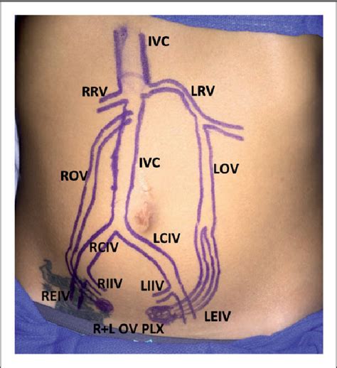 Figure From A Standardized Ultrasound Approach To Pelvic Congestion