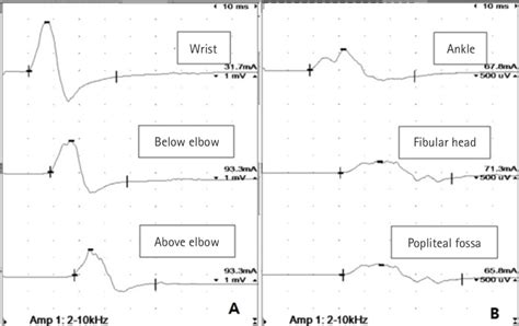 Waveform Morphologies Of Right Ulnar And Common Fibular Nerve Motor