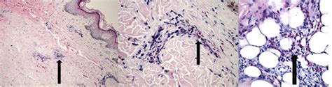 Skin Biopsy Scanning Magnification Shows Necrotizing Eosinophilic