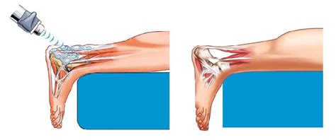 Shockwave Therapy Marin Spine And Sports