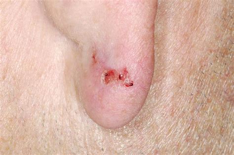 Skin Cancer On Ear Photograph By Dr P Marazzi Science Photo Library