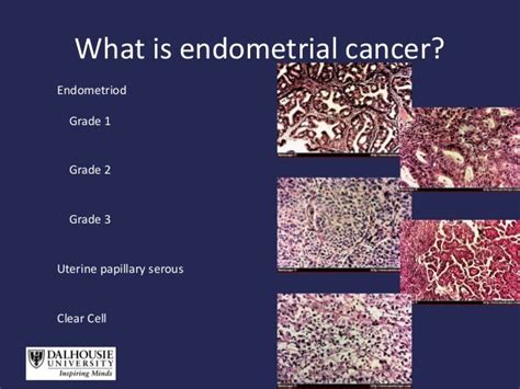 Prof james bently endometrial ca generalist