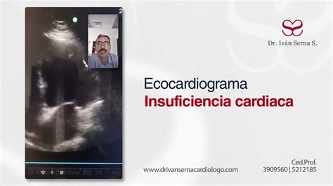 Un Ecocardiograma Es Un Ultrasonido Del Coraz N Youtube