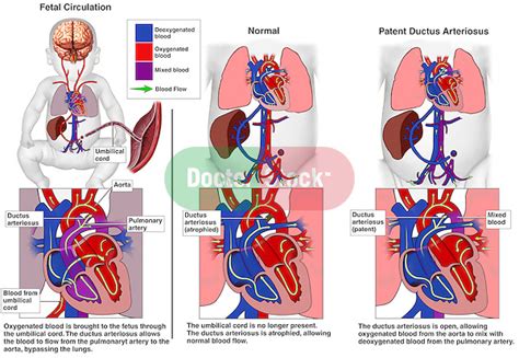 Patent Ductus Arteriosus Doctor Stock