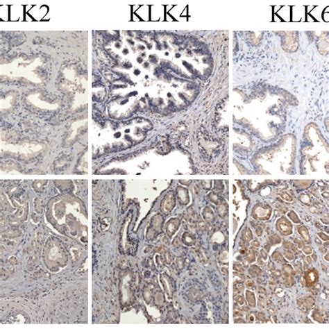 The Immunostaining Of Klk Proteins Showed Significant Differences In