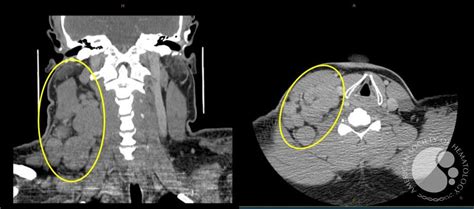 Classical Hodgkin Lymphoma Ct Scan