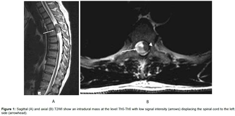 Spinal Schwannoma