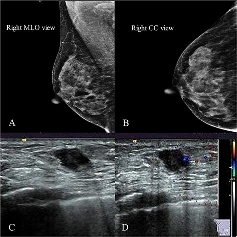 Squamous Cell Carcinoma Ultrasound