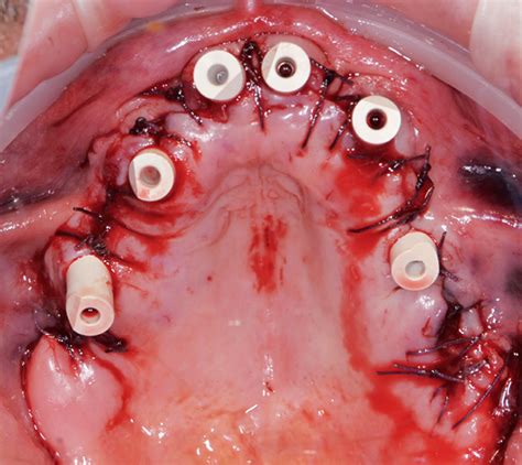 Riabilitazione Totale Dell Arcata Superiore Con Protocollo Interamente