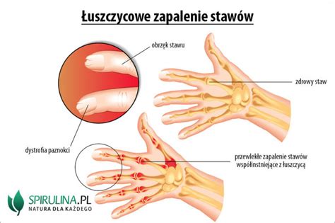 Łuszczycowe zapalenie stawów algi Spirulina i Chlorella