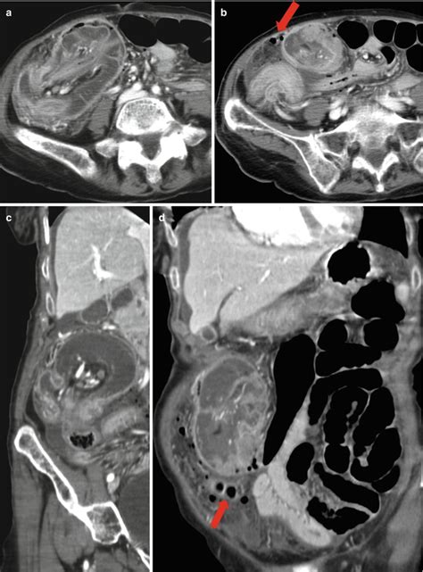 Perforation Of The Colon Leading To Peritonitis Pictures