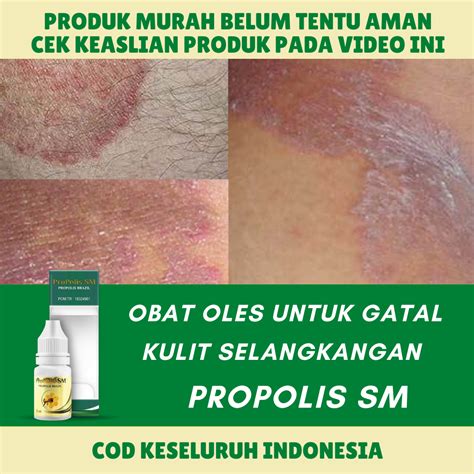 Propolis Sm Solusi Alami Untuk Kulit Kulit Selangkangan Lecet Obat