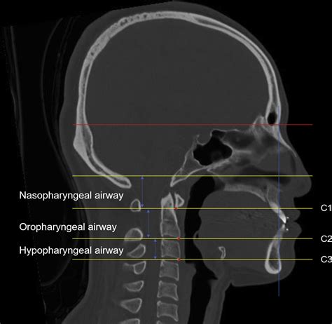 Pharyngeal Airway Morphology In Skeletal Class Iii With Mandibular