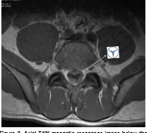 Figure 2 From Inverted Mercedes Benz Sign In Lumbar Spinal Subdural