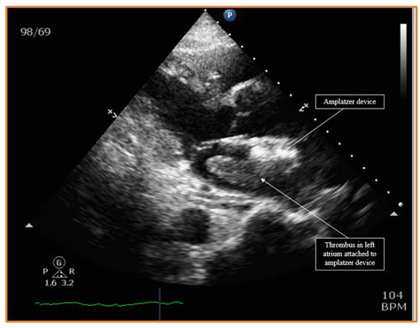 Figure 2 Parasternal Long Axis View Of The Transthoracic