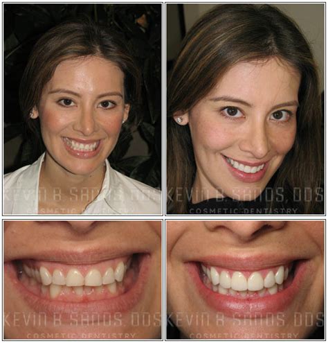 Porcelain Veneers Before and After