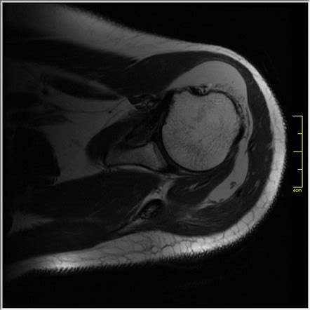 Subacromial Bursitis MRI