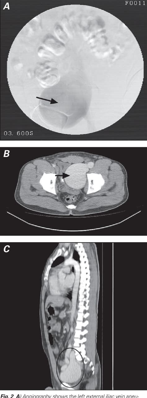 Figure 2 From Surgical Treatment Of A Giant External Iliac Vein