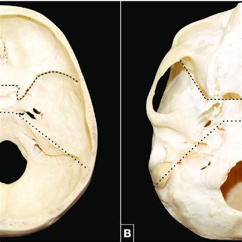 A Endocranial Surface Of The Skull Base The Border Between The