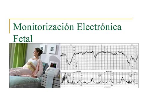 Calam O Clase Monitorizaci N Electr Nica Fetal