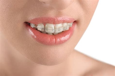 A Comparison Of Invisalign Vs Ceramic Braces Dr Amy James