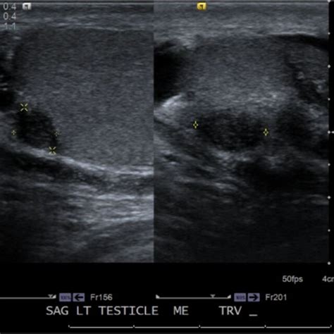 Pdf Adenomatoid Tumor Of The Testis A Rare Case Report