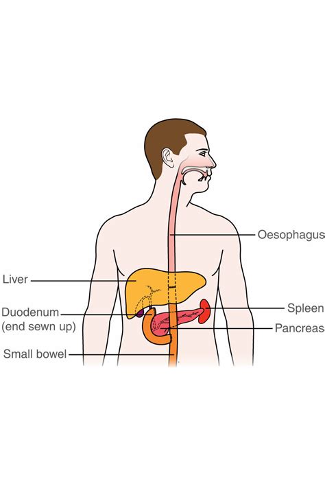 Total Gastrectomy