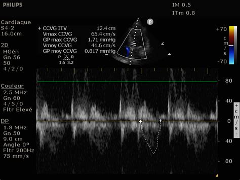 Cours Us Principes De Base Doppler Pulsé