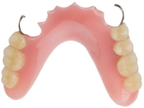 Prosthetics Point 71 Designing Acrylic Resin Removable Partial Dentures With Wrought Wire