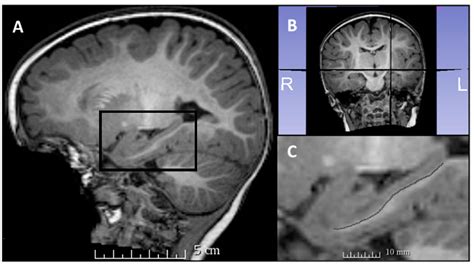 Hippocampus Brain Mri