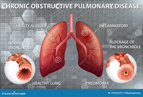 Chronisch Obstruktive Lungenerkrankung Vektor Abbildung Illustration