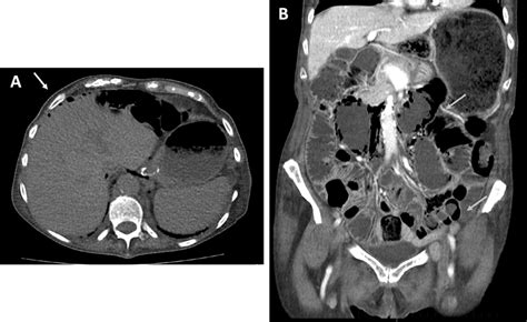 Computed Tomography Of The Abdomen And Pelvis Demonstrating Extensive