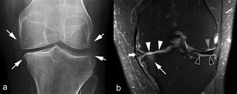 Osteophytes Knee