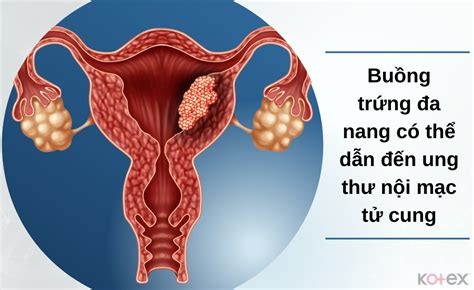 Buồng Trứng Đa Nang Nguyên Nhân Triệu Chứng Chẩn Đoán Và Điều Trị