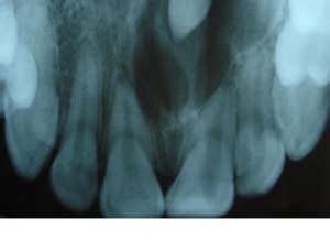 Maxillary Occlusal Radiograph Showing Well Defined Oval Radiolucent