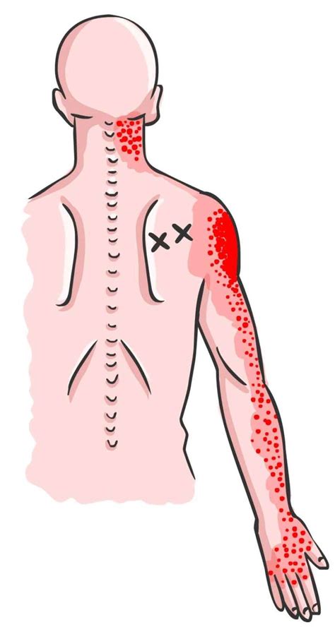 Infraspinatus Of Onderdoornspier Triggerpoint Reset Methode