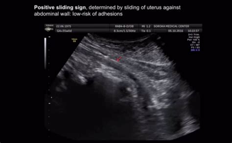 Sliding Sign In Third‐trimester Sonographic Evaluation Of Intra‐abdominal Adhesions In Women