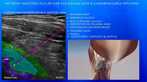 Ultrasound Guided Hip Joint Injection With In A 58 Year Old Female With