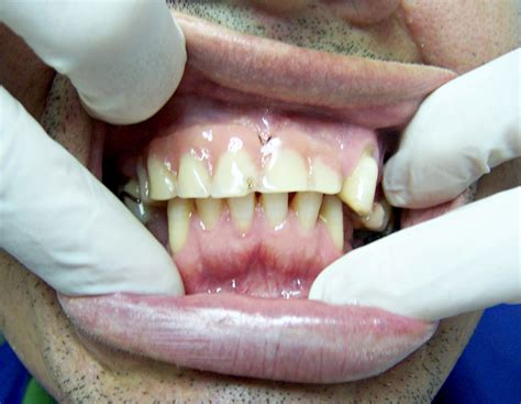 Prótesis Fijas Coronas Dentales Clinica Dental Sonrisalud