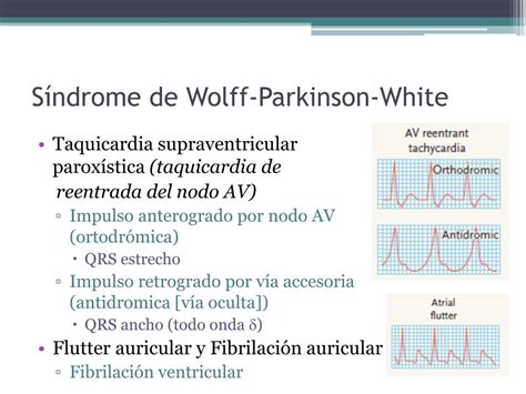 Ppt Extrasistolia Ventricular Síndromes De Preexitacion Wolff