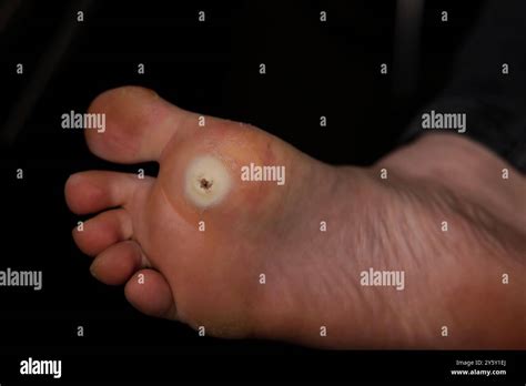 plantar wart bottom   foot hpv viral infection stock photo alamy