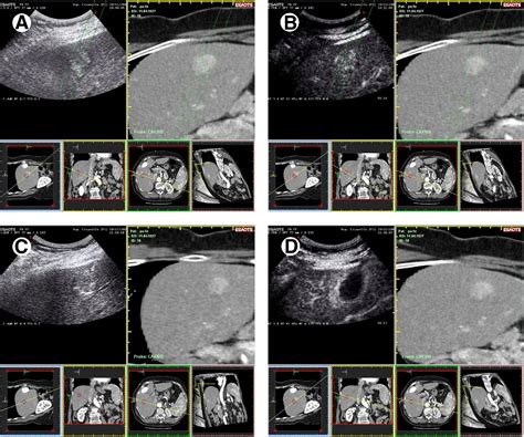 Radiofrequency Ablation Of Liver Cancer Techniques In Vascular