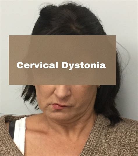 What Is Cervical Dystonia
