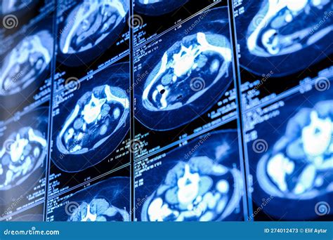 Computed Tomography Ct Scan Of Chest With Abdomen Stock Image Image