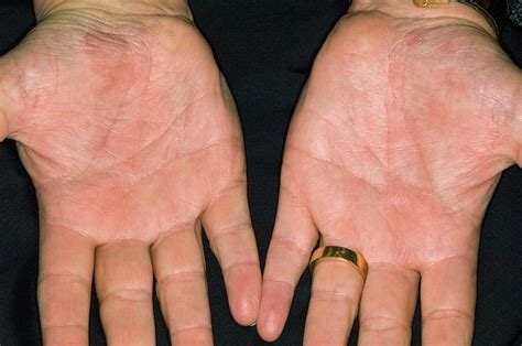 Psoriasis On The Palm Of The Hands Photograph By Dr P Marazziscience Photo Library